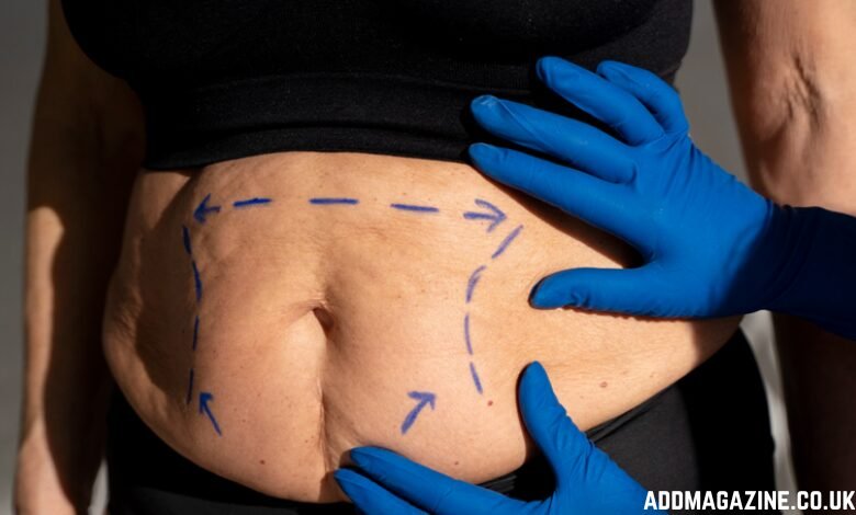 London vaser liposuction