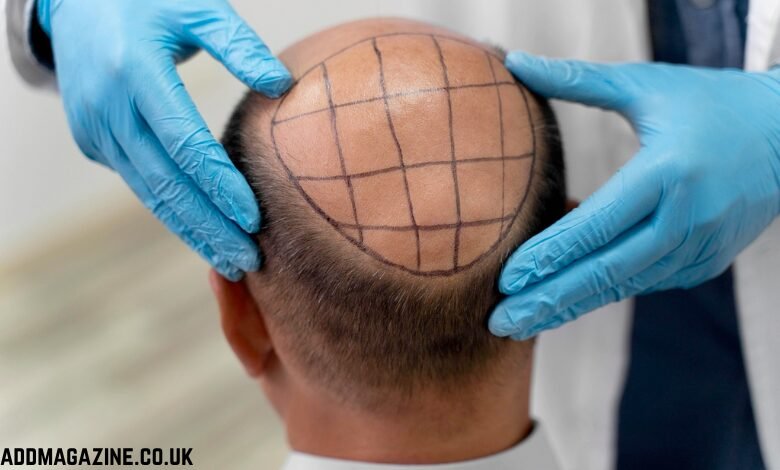 Hair Transplant London