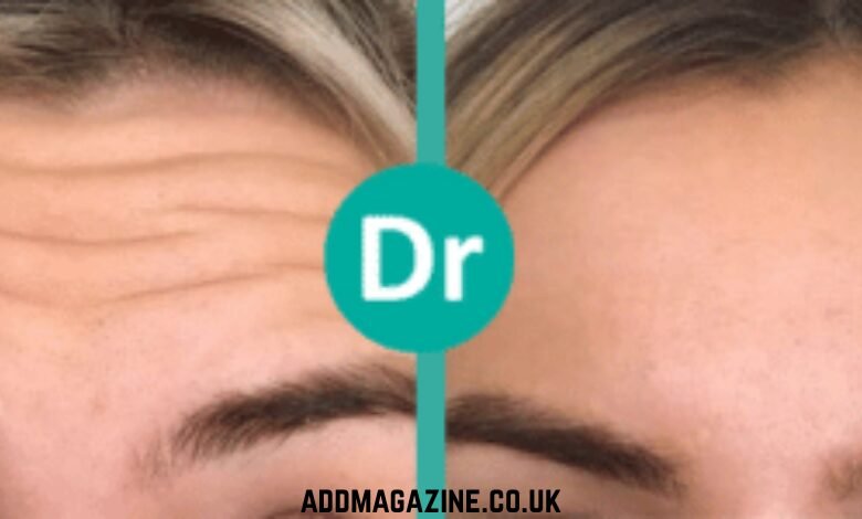 Address Smile Lines with Nasolabial Filler: What You Need to Know