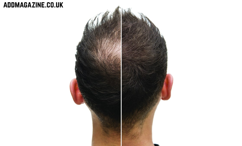 How Long Does It Take for Hair Loss Treatment to Show Results?