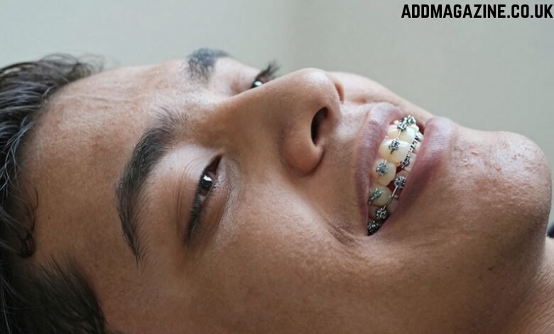 What to Know Before Choosing Low-Cost Braces in Anaheim