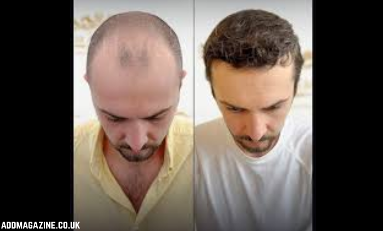 Hair Transplant Cost in Greece: Graft Pricing, Clinics, and Long-Term Value