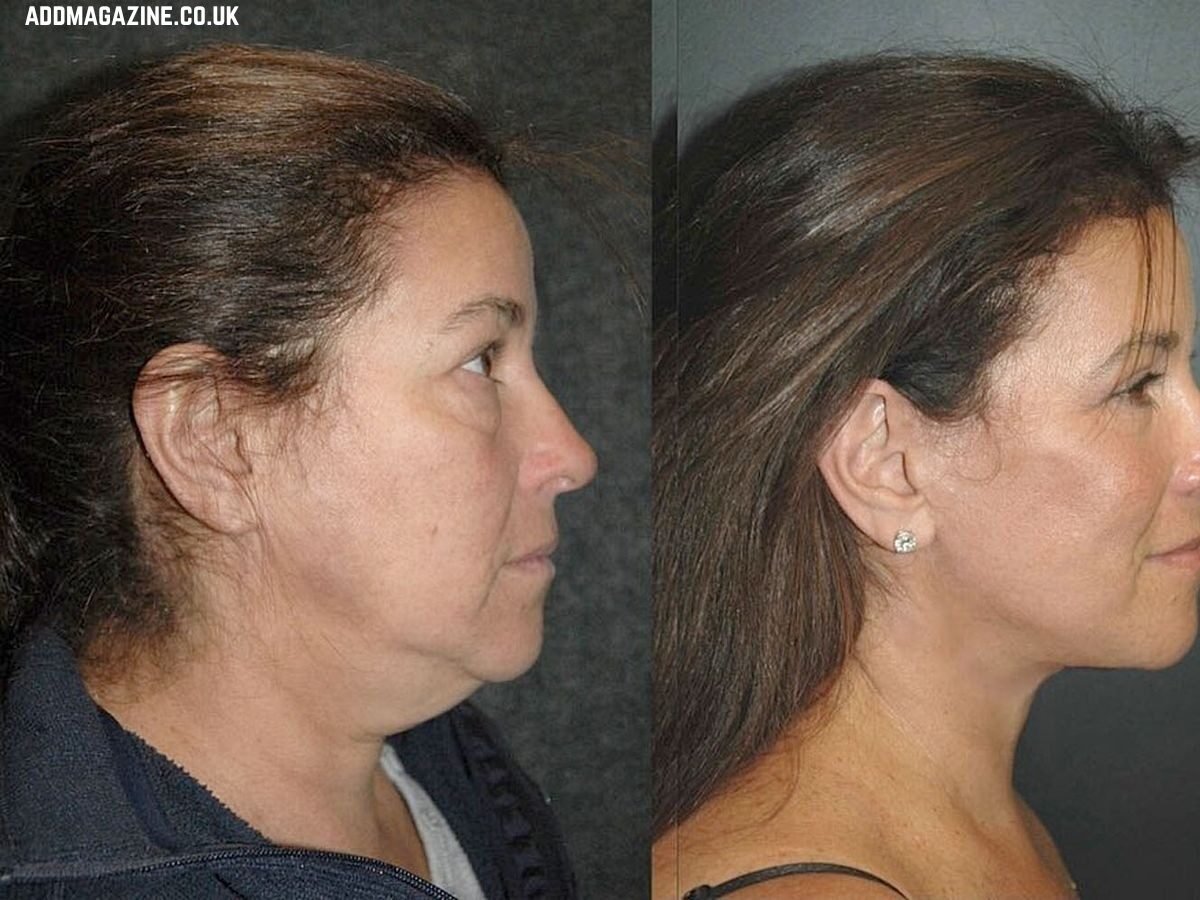 deep plane face & neck lift Glasgow
