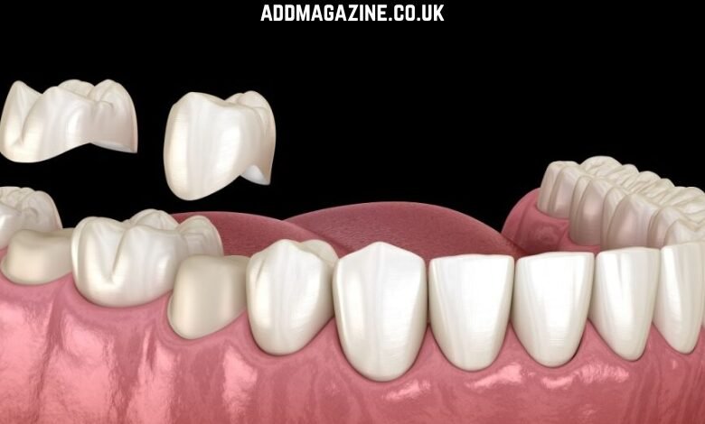 Dental Crowns in Turkey